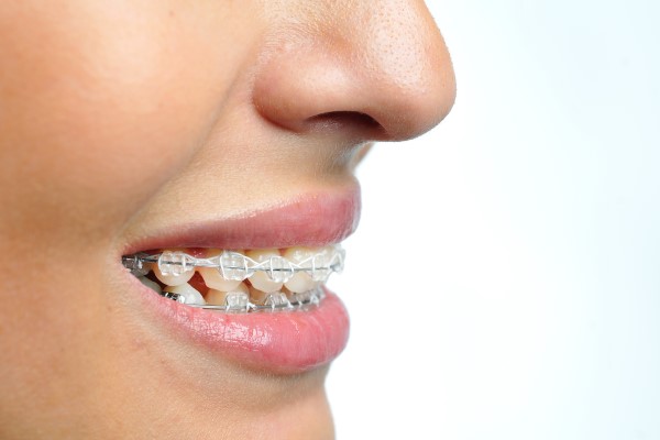Clear Braces: A Discreet Solution For Crooked Teeth