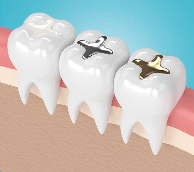 Commerce Composite Fillings