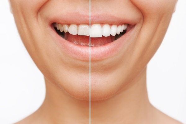 The Role Of A Cosmetic Dentist In Smile Aesthetics