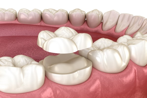 Dental Crown Placement To Restore Damaged Teeth