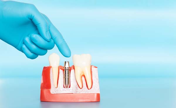 Reasons To Consider Dental Implants To Replace Multiple Missing Teeth