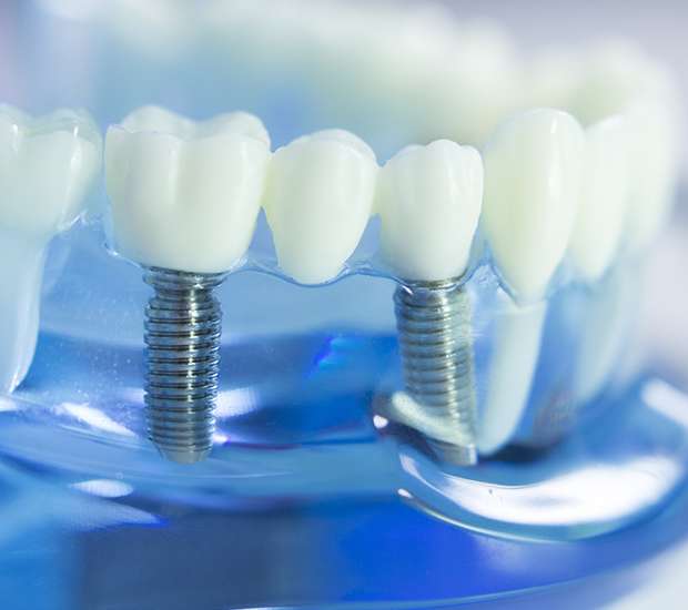 Commerce Dental Implants