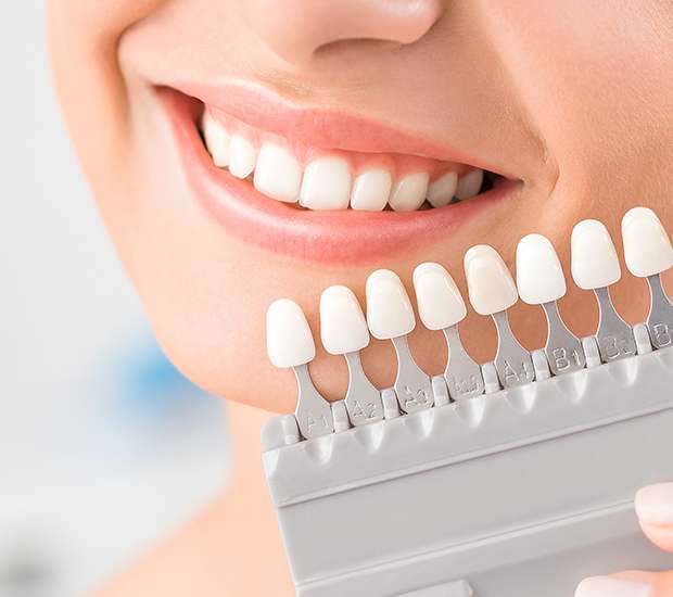 Commerce Dental Veneers and Dental Laminates