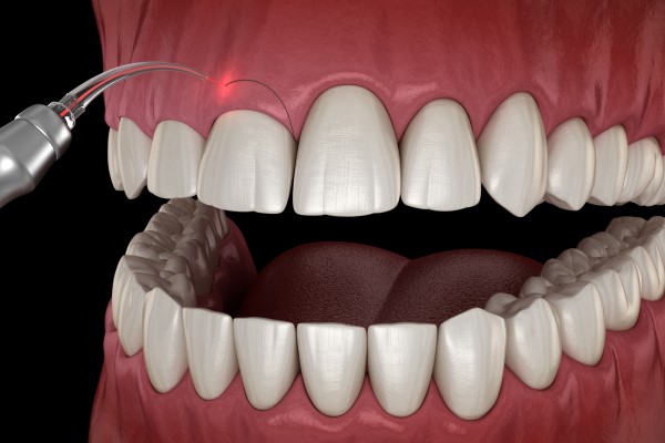 See A Laser Dentist For A Painless Treatment