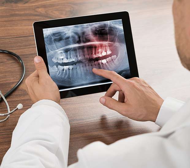 Commerce Types of Dental Root Fractures